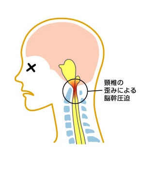 頚椎の歪みによる脳幹圧迫